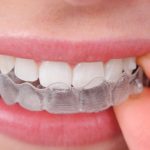 Bruxismo: ¿dolor en los dientes sin razón?