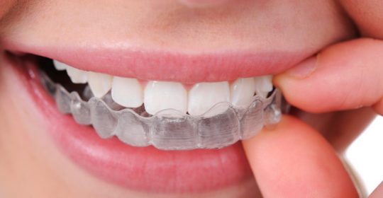 Bruxismo: ¿dolor en los dientes sin razón?