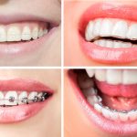Tipos de ortodoncia