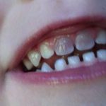 ¿Por qué el diente cambia de color?