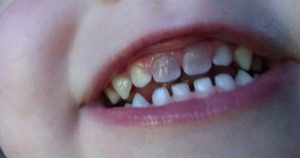 decoloración dental