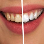 Prevenir el sarro en los dientes