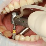 Preiimplantitis: importancia de la higiene bucal con implantes