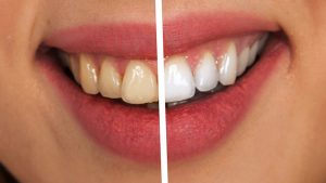 antiaging dental para rejuvenecer la sonrisa
