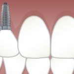 Pérdida dental e implante dental unitario
