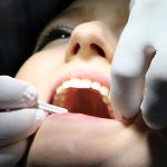 Manchas blancas en los dientes y cómo tratarlas